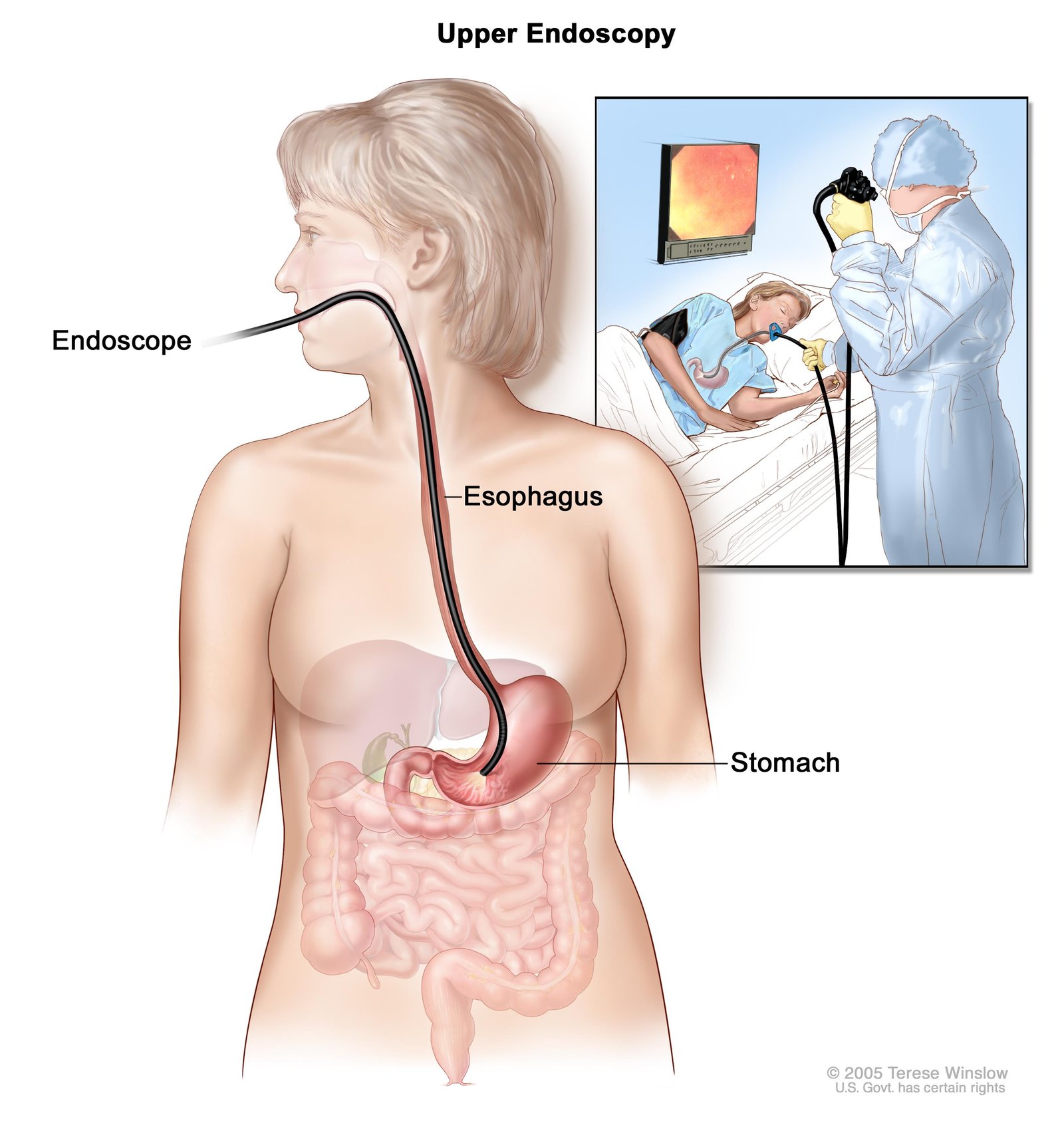 Gastrointestinal (GI) cancer